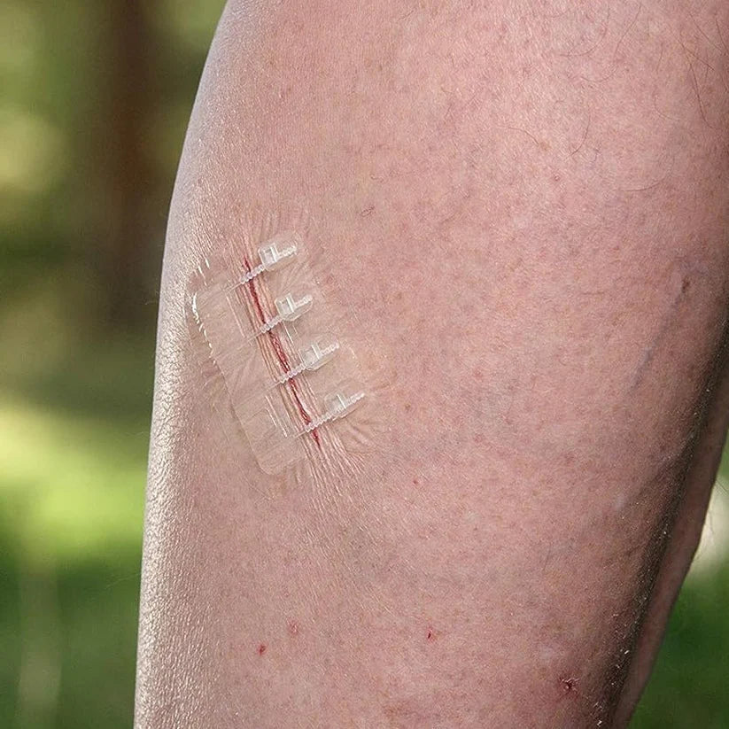 Wound Closure Kit – 2 Pcs, Suture-Free Strips